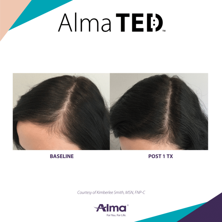 Alma TED Silk Touch Hair Restoration