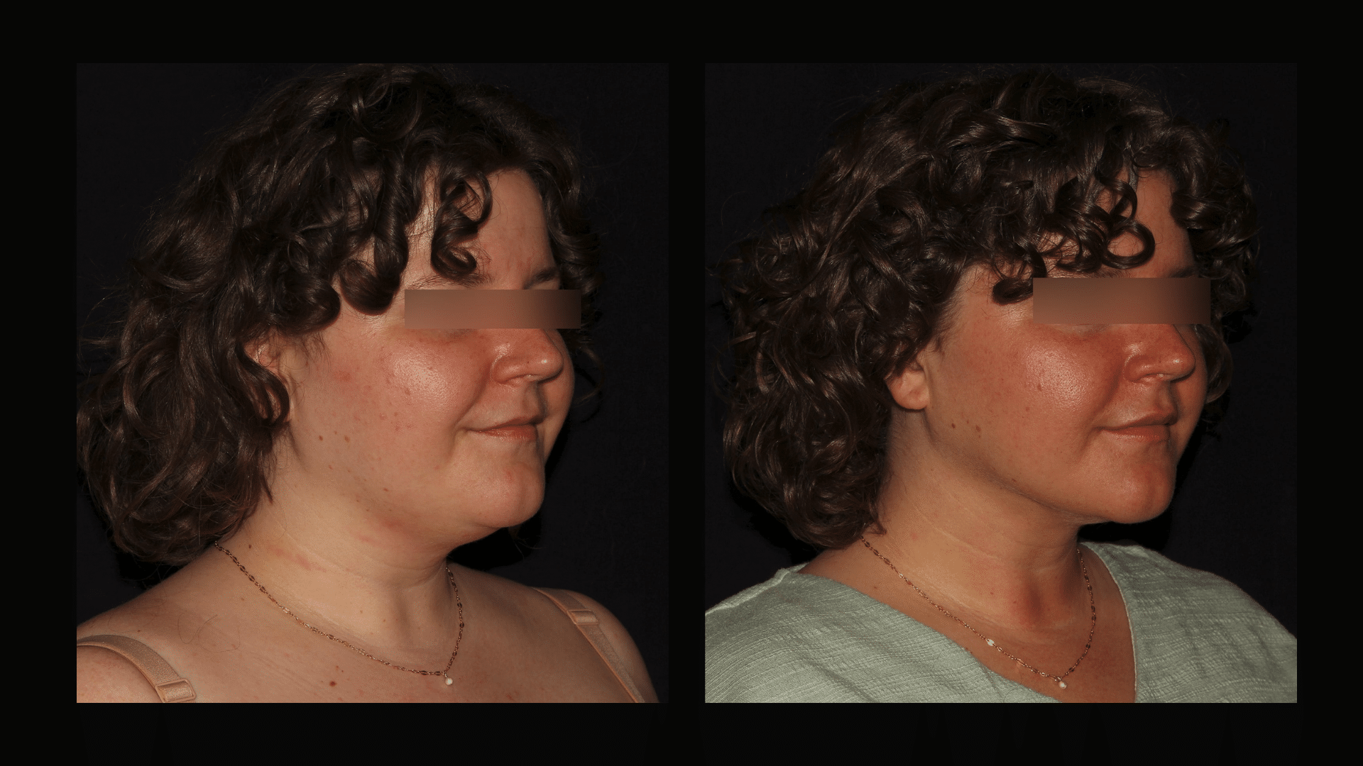 Neck Lipo before and after of female at Silk Touch Cosmetic Surgery and Medspa