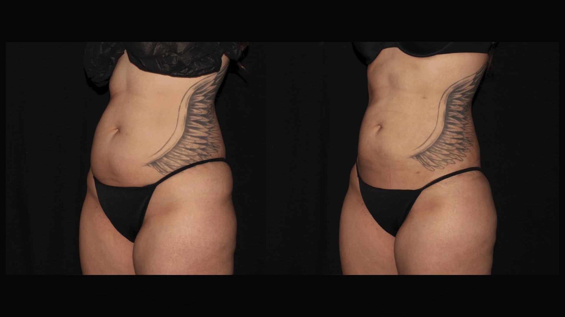 female Liposuction of the abdomen before and after at Silk Touch Cosmetic Surgery &
