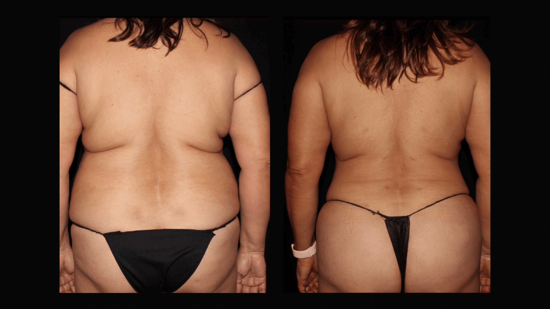 female Liposuction of the back before and after at Silk Touch Cosmetic Surgery &