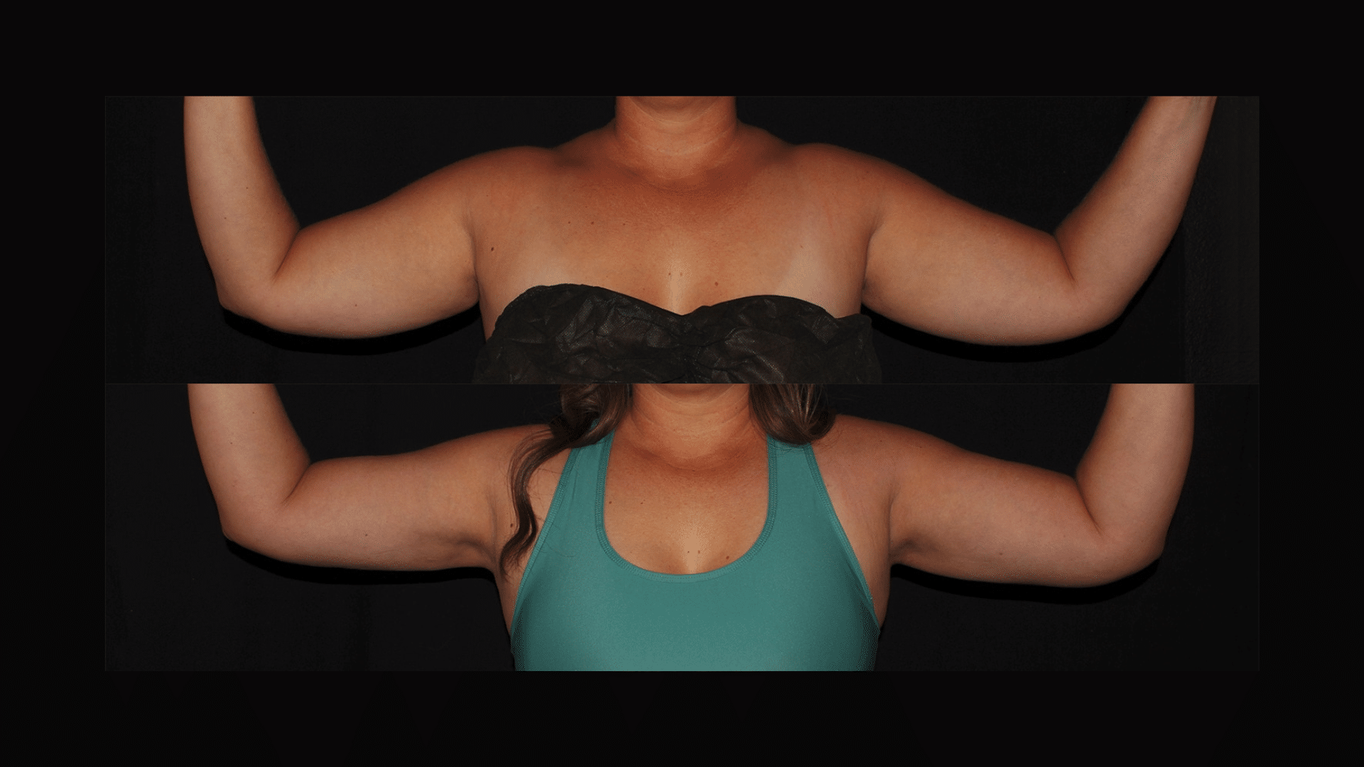 female Liposuction of the upper arms before and after at Silk Touch Cosmetic Surgery &