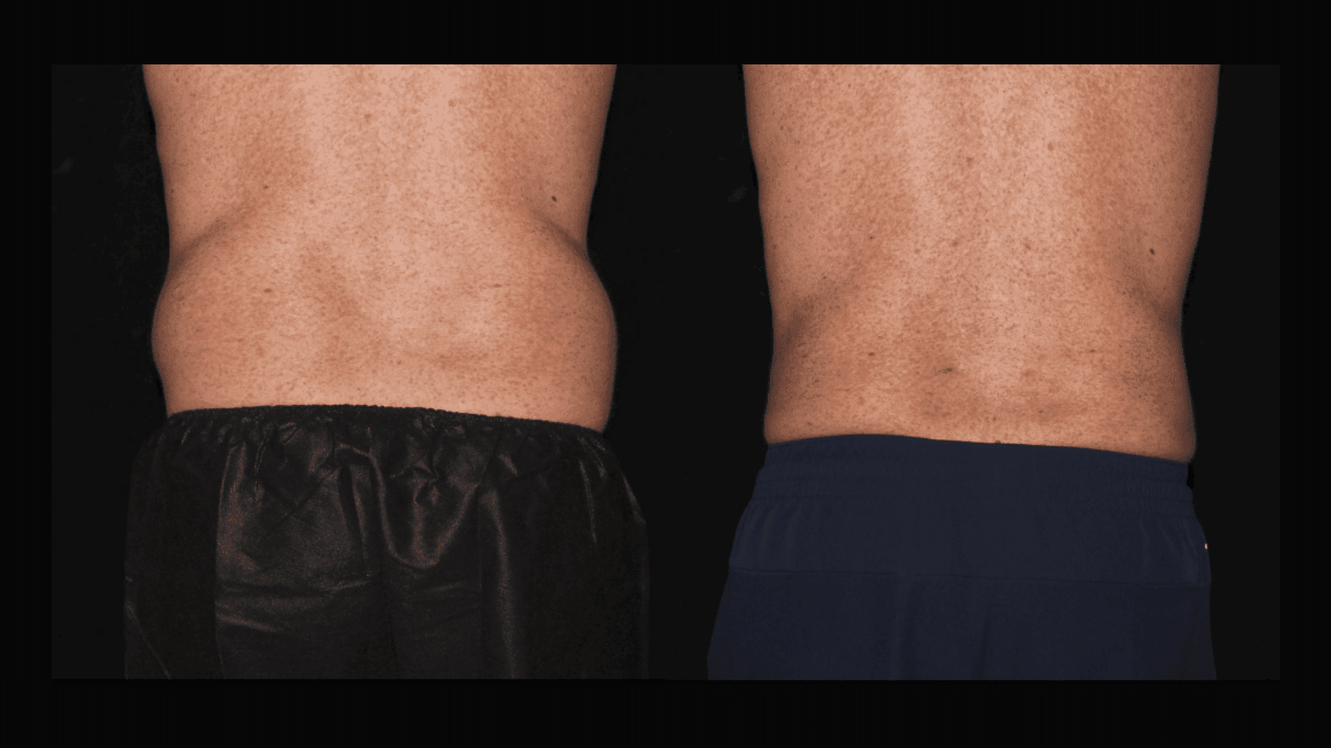 male Liposuction of the back flanks before and after at Silk Touch Cosmetic Surgery &