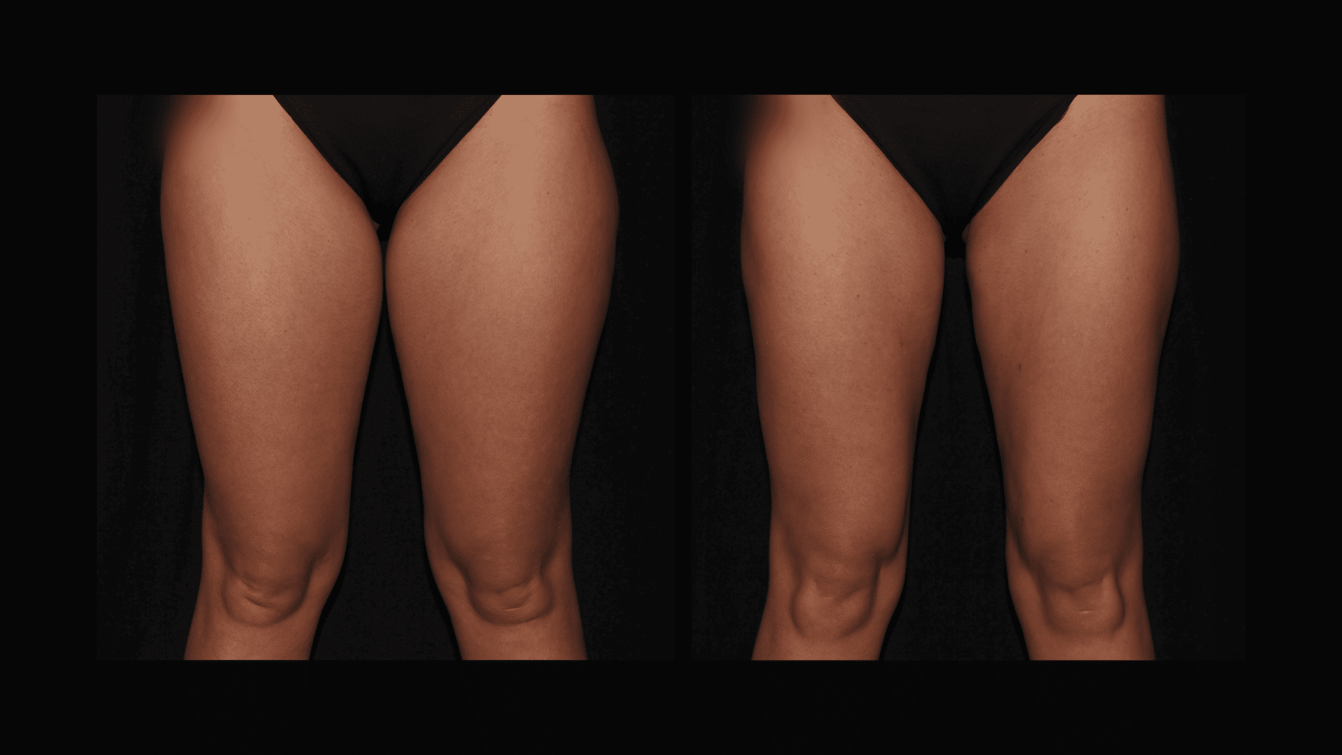 female Liposuction of the upper thighs before and after at Silk Touch Cosmetic Surgery &