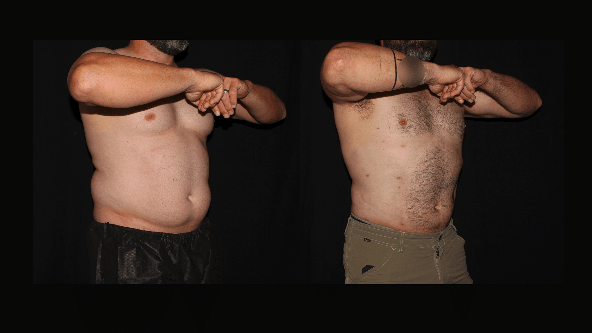 Male Liposuction of the abdomen before and after at Silk Touch Cosmetic Surgery &