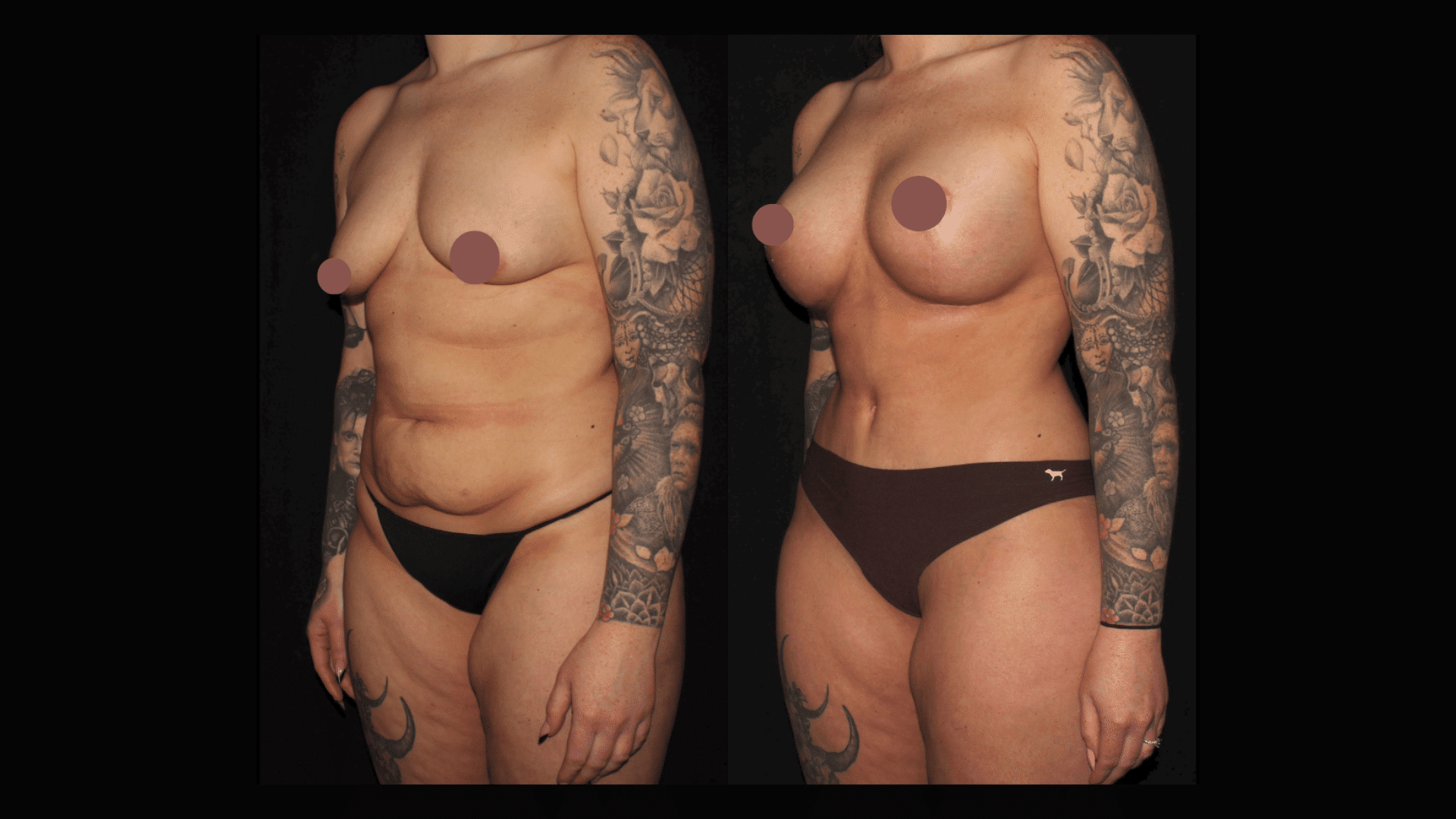 Mommy Makeover: Breast Augmentation + Tummy Tuck at Silk Touch Cosmetic Surgery & Medspa