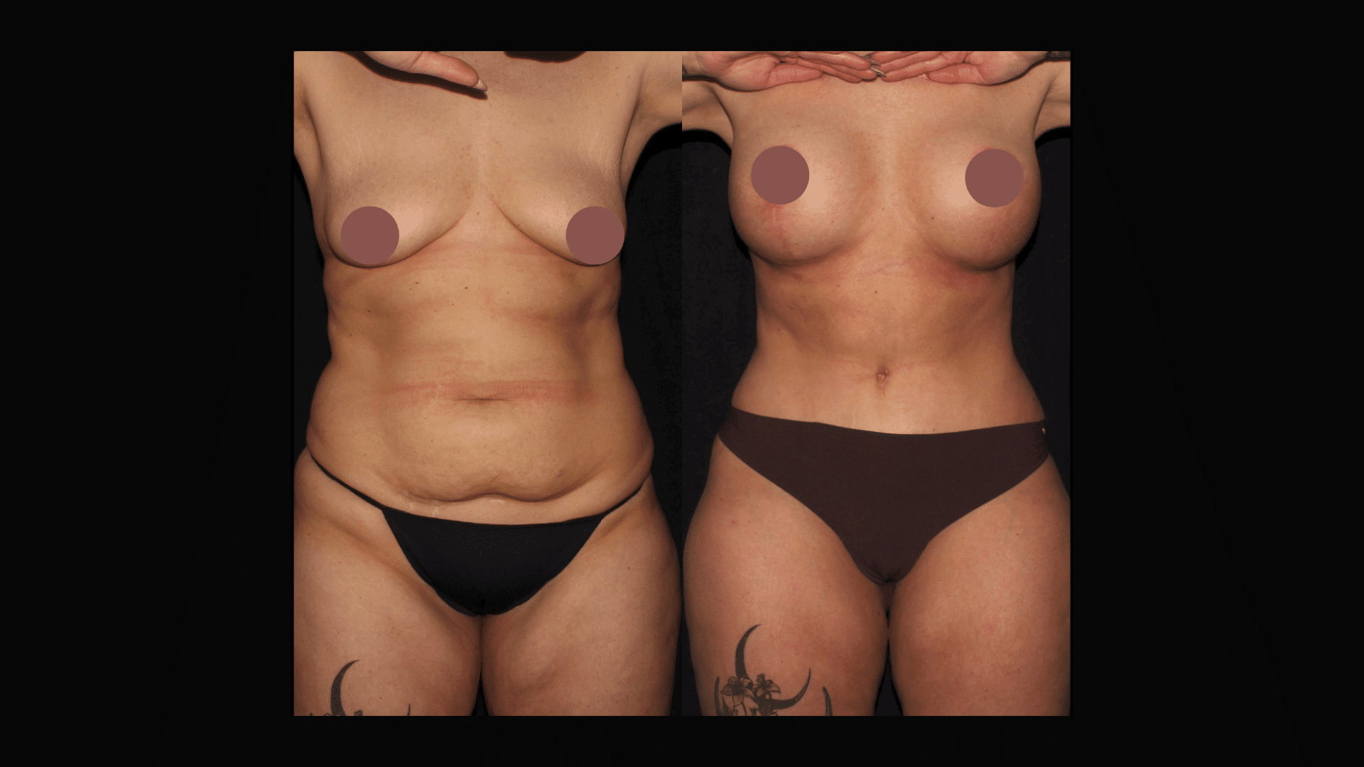 Mommy Makeover: Breast Augmentation + Tummy Tuck at Silk Touch Cosmetic Surgery & Medspa