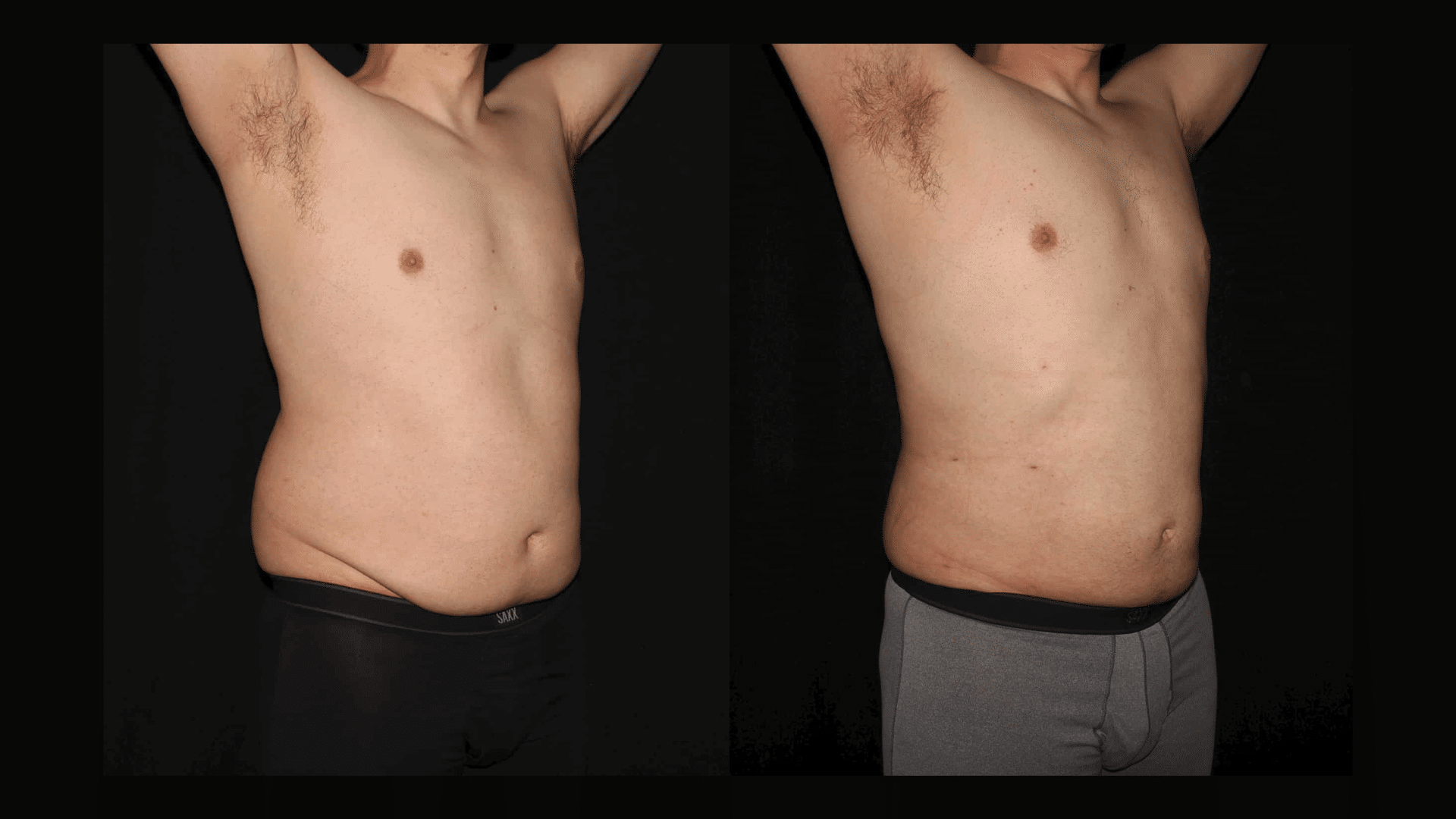 Male Liposuction of the abdomen before and after at Silk Touch Cosmetic Surgery & Medspa