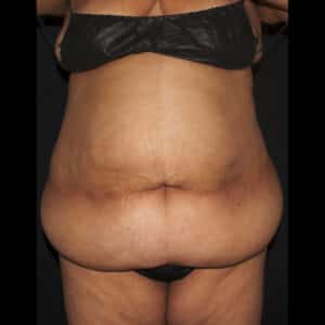 Abdomen & Waist Liposuction