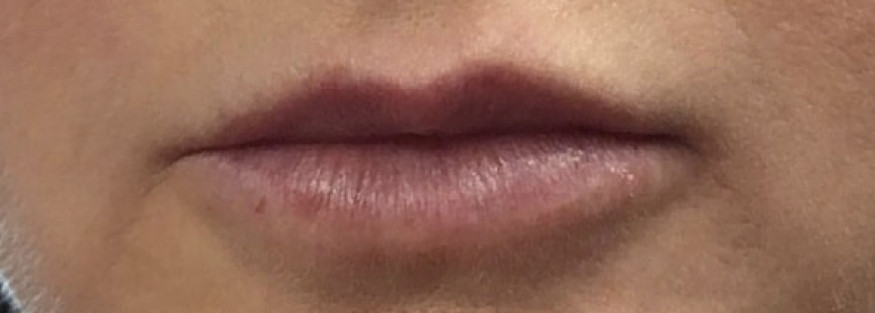 Lip Enhancement with Filler