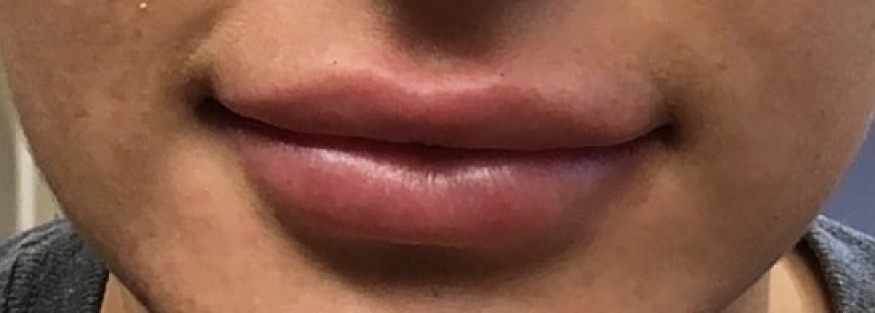 Lip Enhancement with Filler