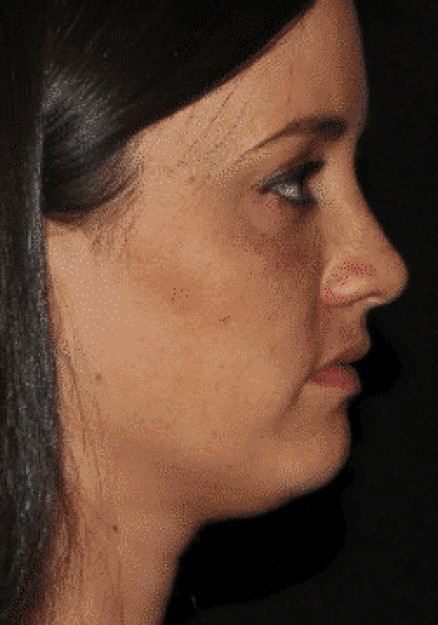 Kybella Injectable for Double Chin
