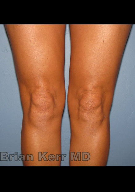 Knee Liposuction, SmartLipo, Vaser