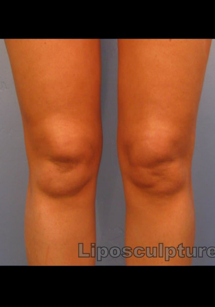 Knee Liposuction, SmartLipo, Vaser